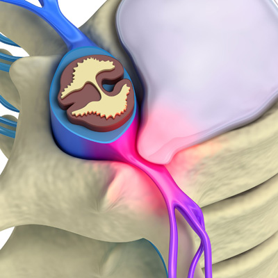 Sciatica